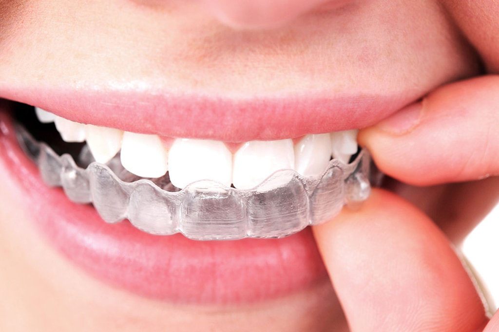 Care of Invisalign Aligners - McElhinney & Breha Orthodontics